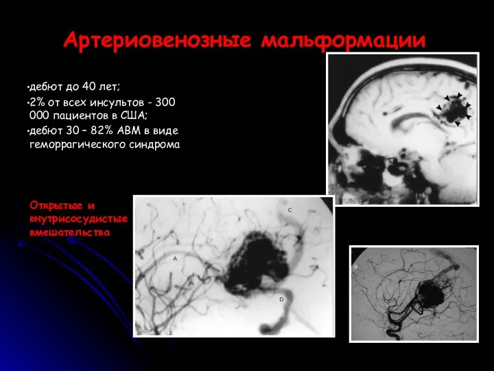 Артериовенозные мальформации дебют до 40 лет; 2% от всех инсультов