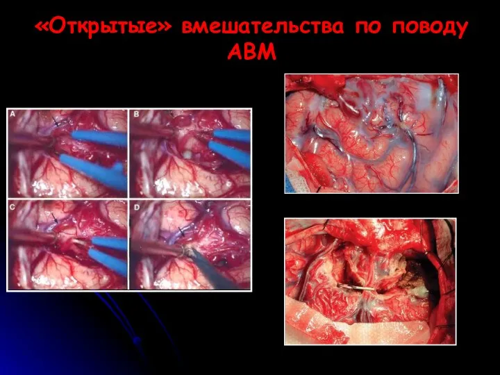 «Открытые» вмешательства по поводу АВМ