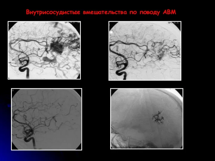 Внутрисосудистые вмешательства по поводу АВМ