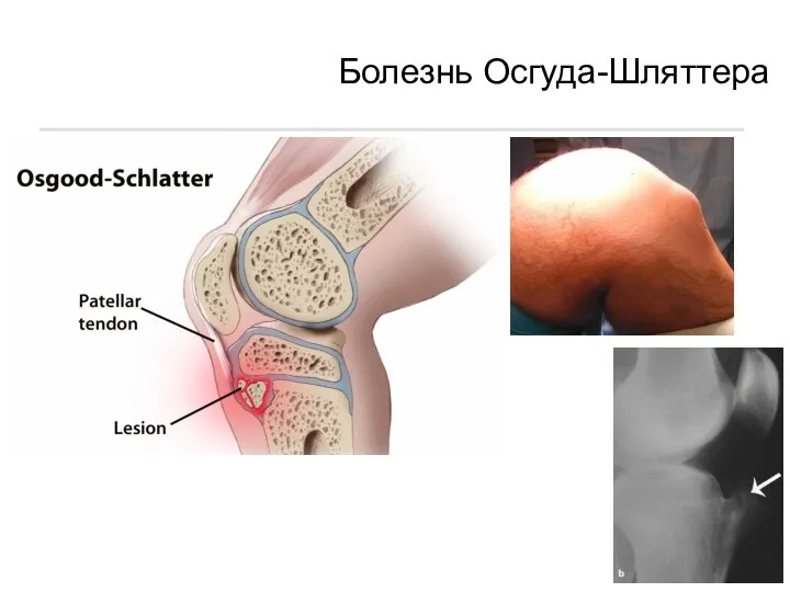 Болезнь Осгуда-Шляттера