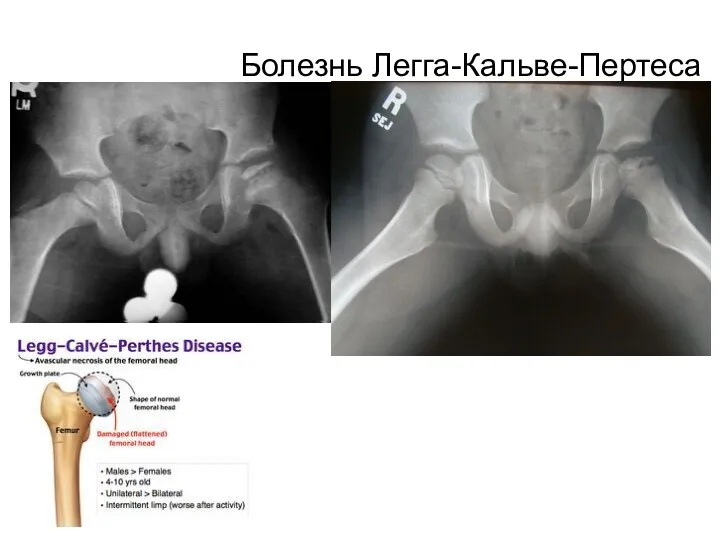 Болезнь Легга-Кальве-Пертеса