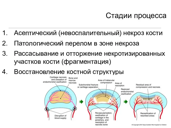 Стадии процесса Асептический (невоспалительный) некроз кости Патологический перелом в зоне