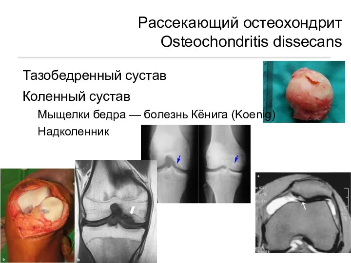 Рассекающий остеохондрит Osteochondritis dissecans Тазобедренный сустав Коленный сустав Мыщелки бедра — болезнь Кёнига (Koenig) Надколенник