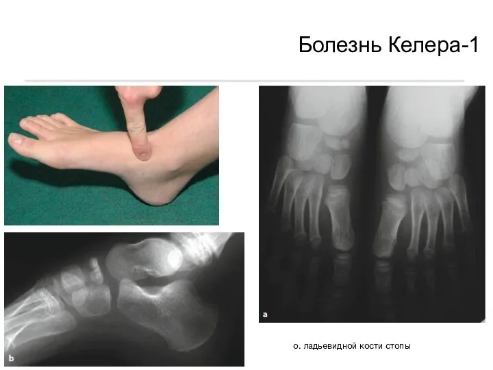 Болезнь Келера-1 о. ладьевидной кости стопы