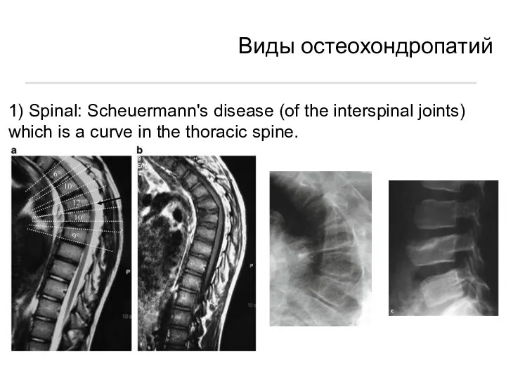 1) Spinal: Scheuermann's disease (of the interspinal joints) which is