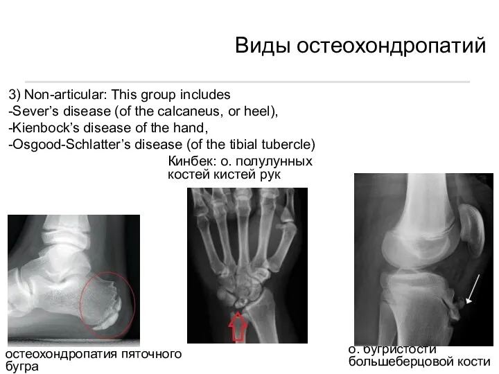 3) Non-articular: This group includes -Sever’s disease (of the calcaneus,