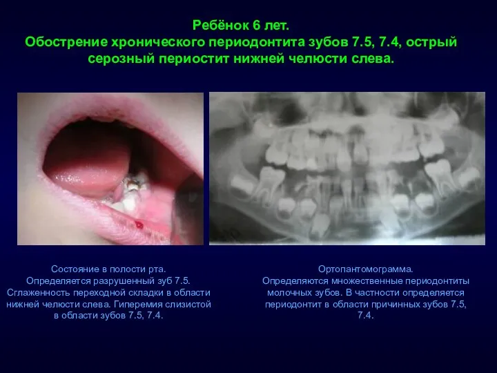 Состояние в полости рта. Определяется разрушенный зуб 7.5. Сглаженность переходной складки в области