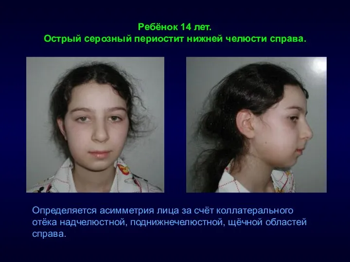 Ребёнок 14 лет. Острый серозный периостит нижней челюсти справа. Определяется асимметрия лица за