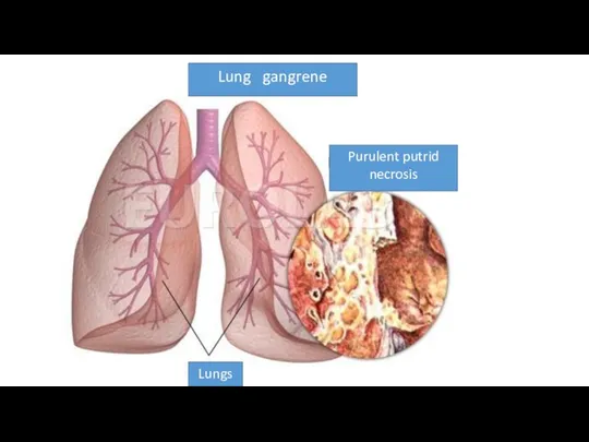 Lung gangrene Purulent putrid necrosis Lungs