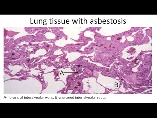 Lung tissue with asbestosis А-fibrosis of interalveolar walls, В-unaltered inter alveolar septa. А В