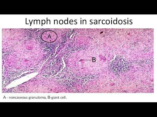 Lymph nodes in sarcoidosis А - noncaseous granuloma, В-giant cell. А В