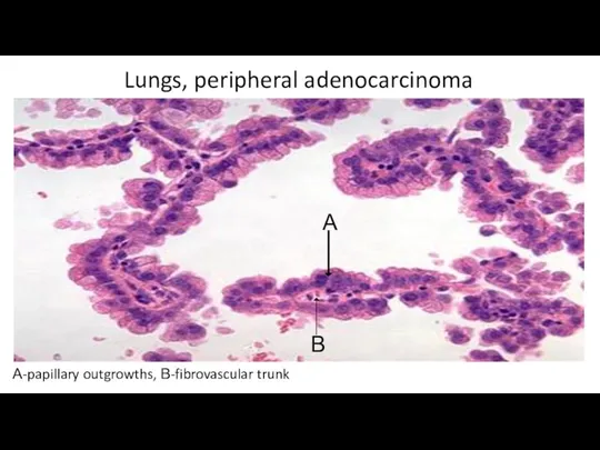 Lungs, peripheral adenocarcinoma А-papillary outgrowths, В-fibrovascular trunk А В