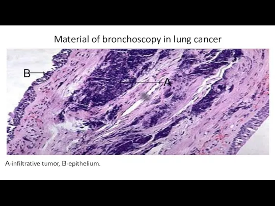 Material of bronchoscopy in lung cancer А-infiltrative tumor, В-epithelium. А В