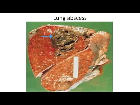 Lung abscess