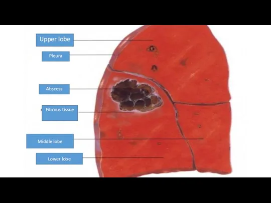 Upper lobe Pleura Abscess Fibrous tissue Middle lobe Lower lobe