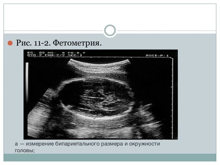 Рис. 11-2. Фетометрия. а — измерение бипариетального размера и окружности головы;