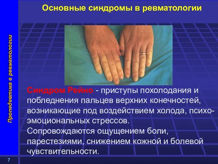 Основные синдромы в ревматологии Синдром Рейно - приступы похолодания и побледнения пальцев верхних
