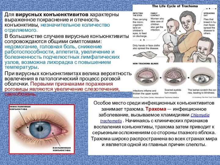 Особое место среди инфекционных конъюнктивитов занимает трахома. Трахома — инфекционное