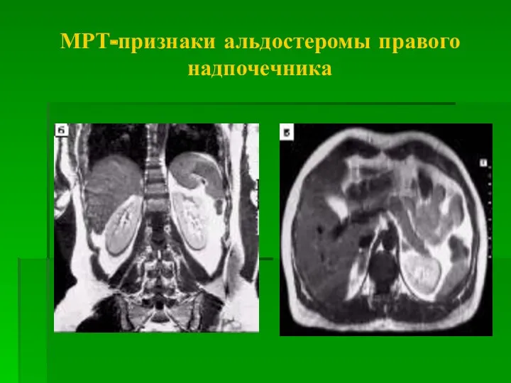 МРТ-признаки альдостеромы правого надпочечника