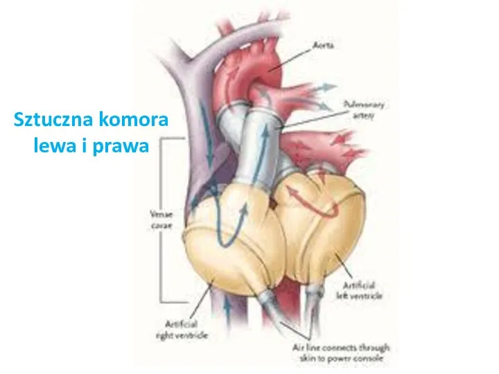 Sztuczna komora lewa i prawa