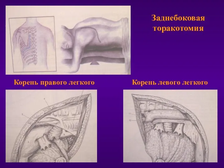 Заднебоковая торакотомия Корень правого легкого Корень левого легкого