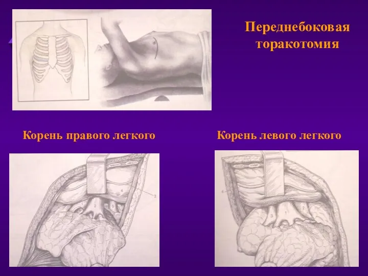 Переднебоковая торакотомия Корень правого легкого Корень левого легкого