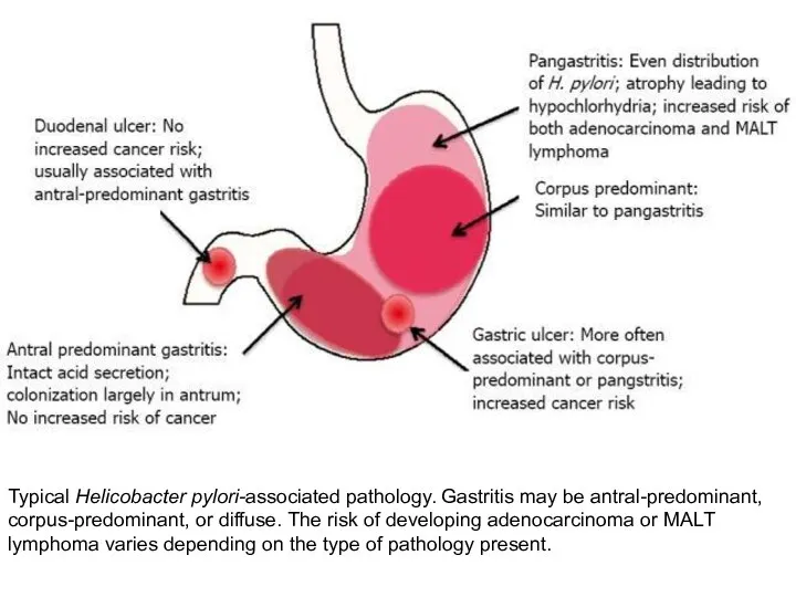 Typical Helicobacter pylori-associated pathology. Gastritis may be antral-predominant, corpus-predominant, or