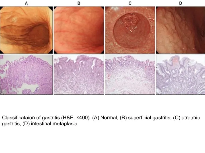 Classificataion of gastritis (H&E, ×400). (A) Normal, (B) superficial gastritis, (C) atrophic gastritis, (D) intestinal metaplasia.