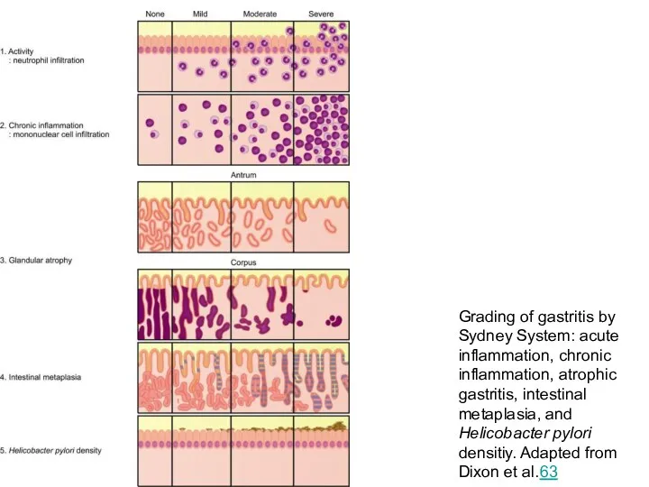 Grading of gastritis by Sydney System: acute inflammation, chronic inflammation,