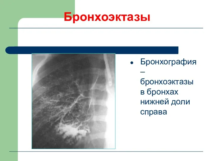 Бронхоэктазы Бронхография – бронхоэктазы в бронхах нижней доли справа