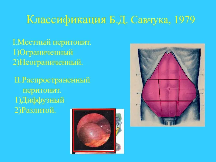 Классификация Б.Д. Савчука, 1979 I.Местный перитонит. 1)Ограниченный 2)Неограниченный. II.Распространенный перитонит. 1)Диффузный 2)Разлитой.