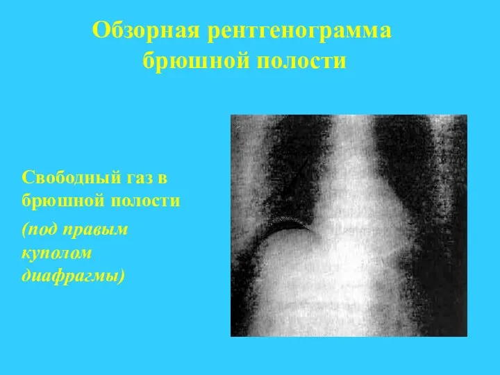 Обзорная рентгенограмма брюшной полости Свободный газ в брюшной полости (под правым куполом диафрагмы)‏