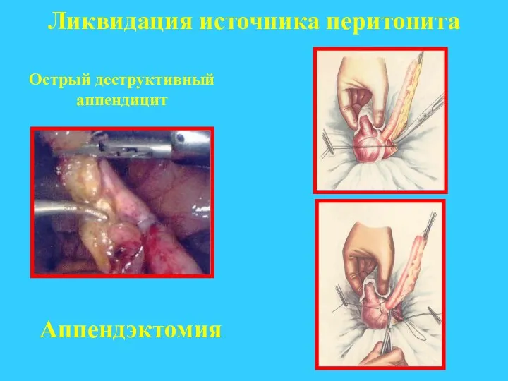 Ликвидация источника перитонита Острый деструктивный аппендицит Аппендэктомия