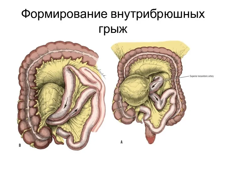 Формирование внутрибрюшных грыж