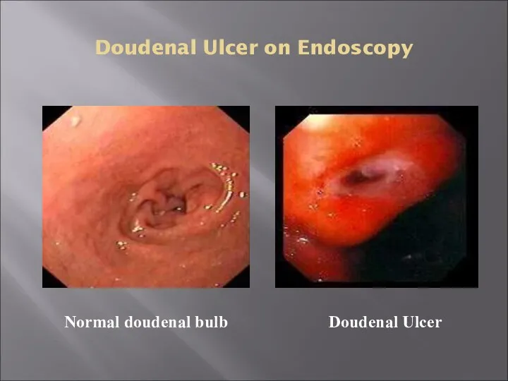 Doudenal Ulcer on Endoscopy Doudenal Ulcer Normal doudenal bulb