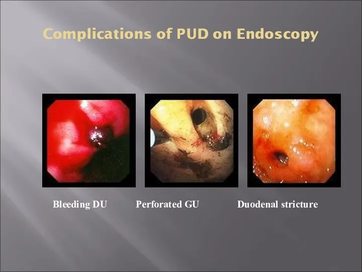Complications of PUD on Endoscopy Bleeding DU Perforated GU Duodenal stricture