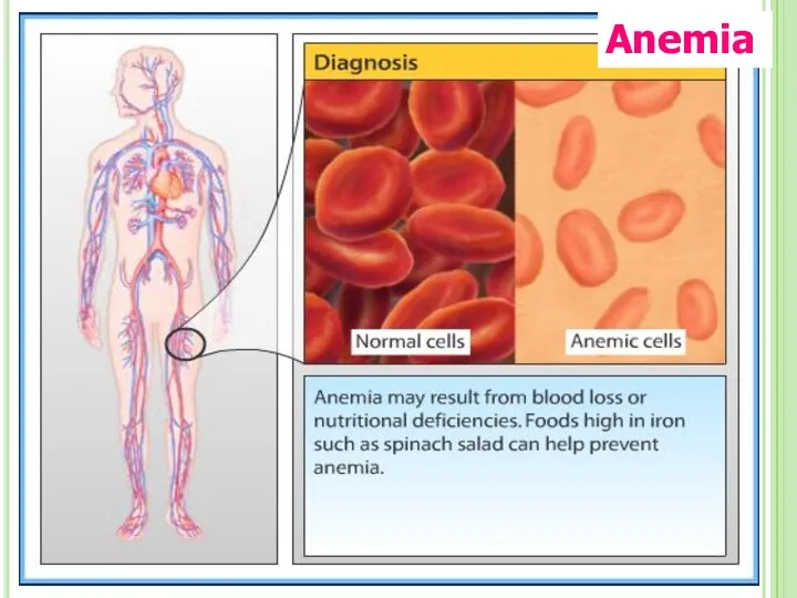 Anemia