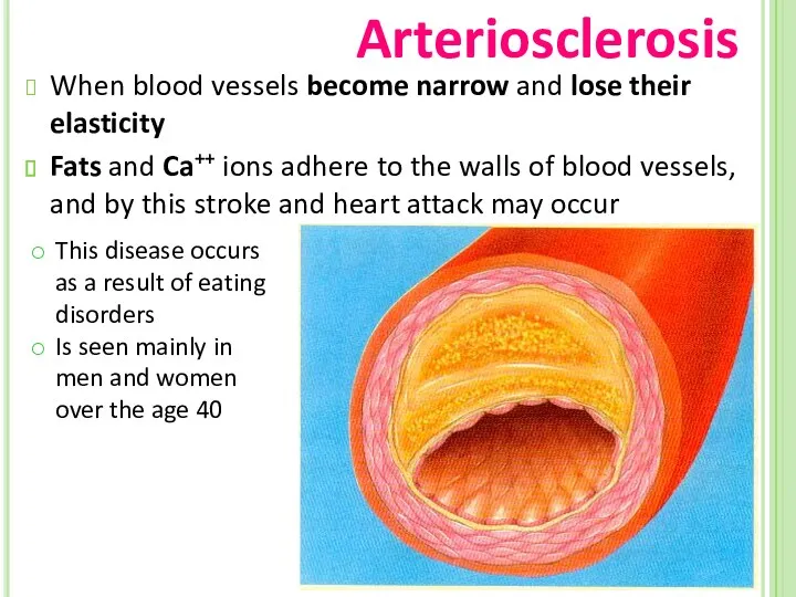 Arteriosclerosis When blood vessels become narrow and lose their elasticity Fats and Ca++