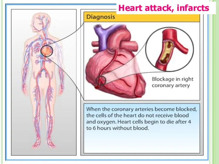 Heart attack, infarcts