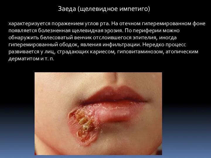 Заеда (щелевидное импетиго) характеризуется поражением углов рта. На отечном гиперемированном фоне появляется болезненная