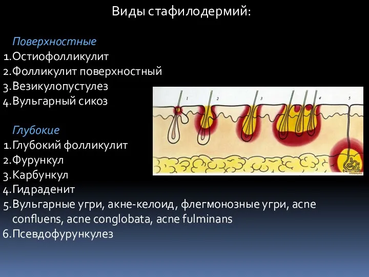 Виды стафилодермий: Поверхностные Остиофолликулит Фолликулит поверхностный Везикулопустулез Вульгарный сикоз Глубокие