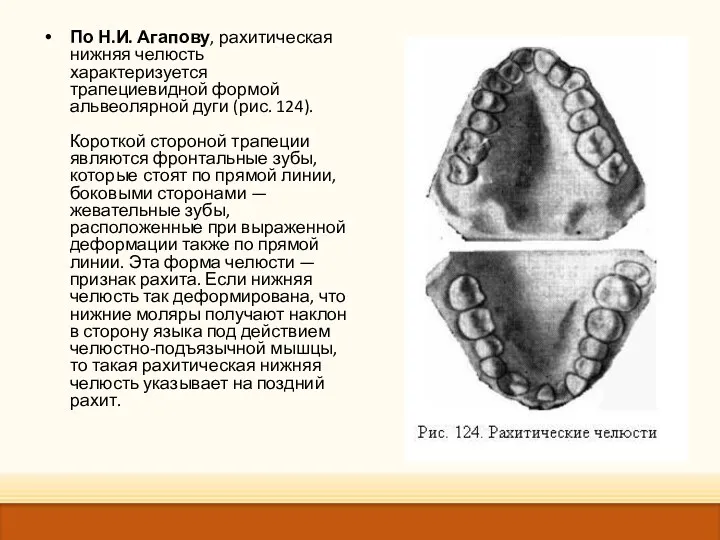 По Н.И. Агапову, рахитическая нижняя челюсть характеризуется трапециевидной формой альвеолярной