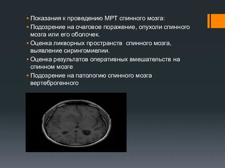 Показания к проведению МРТ спинного мозга: Подозрение на очаговое поражение,