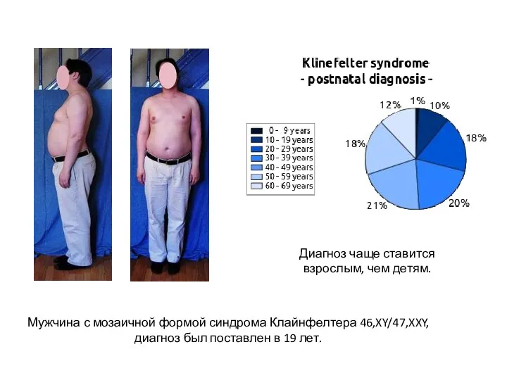 Мужчина с мозаичной формой синдрома Клайнфелтера 46,XY/47,XXY, диагноз был поставлен