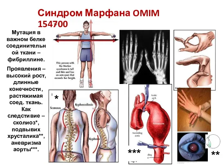 Мутация в важном белке соединительной ткани – фибриллине. Проявления –