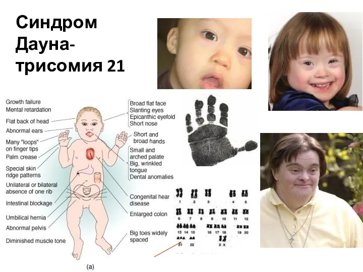 Синдром Дауна- трисомия 21