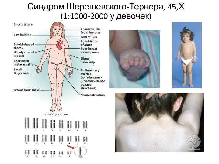 Синдром Шерешевского-Тернера, 45,Х (1:1000-2000 у девочек)