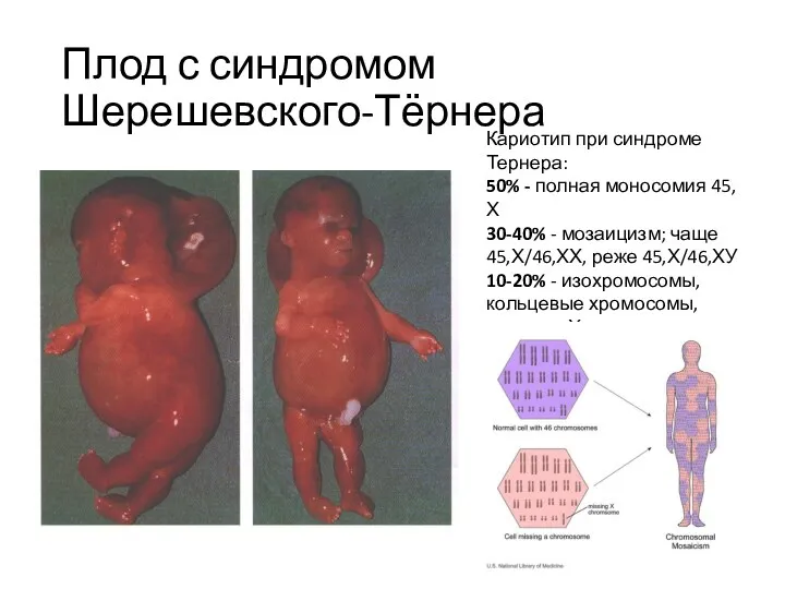 Плод с синдромом Шерешевского-Тёрнера Кариотип при синдроме Тернера: 50% -