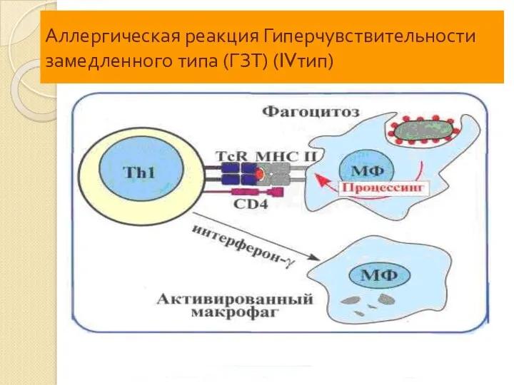 Аллергическая реакция Гиперчувствительности замедленного типа (ГЗТ) (IVтип) лимфокины