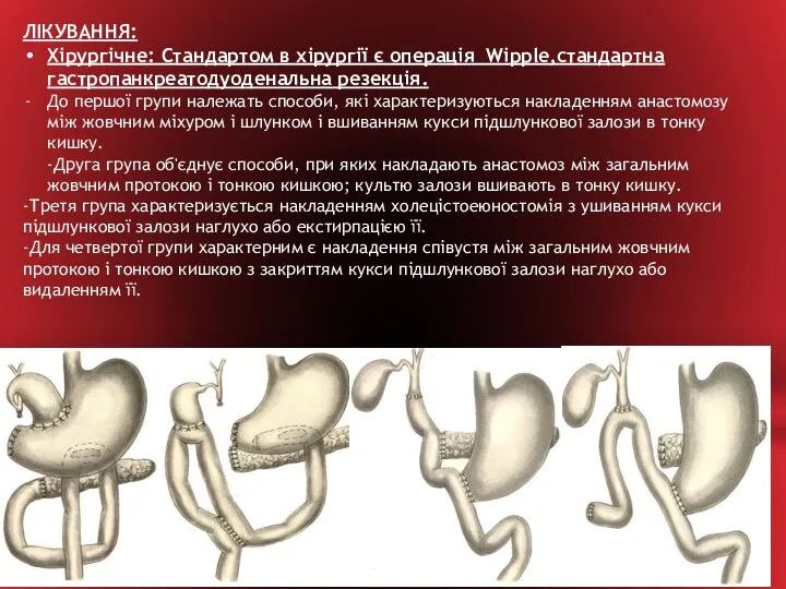 ЛІКУВАННЯ: Хірургічне: Стандартом в хірургії є операція Wipple,стандартна гастропанкреатодуоденальна резекція. До першої групи